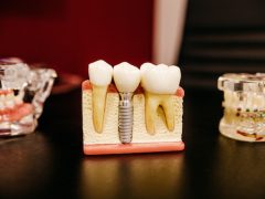 Przykładowy implant zęba