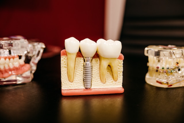 Przykładowy implant zęba